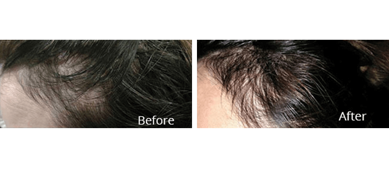 avie-medspa-laser-center-before-after-image-hair-restoration-leesburg-va